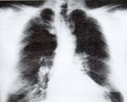 foto-enfisema-pulmonar-01