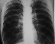 foto-enfisema-pulmonar-04