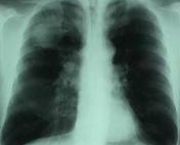 foto-enfisema-pulmonar-06