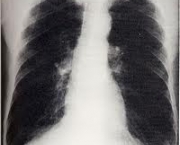 foto-enfisema-pulmonar-07