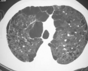 foto-enfisema-pulmonar-09