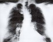 foto-enfisema-pulmonar-14
