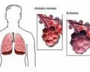 foto-enfisema-pulmonar-15