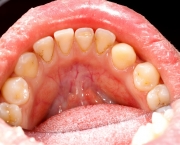 Macro shot of human teeth with tartar and plaque.