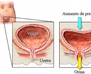 incontinencia-urinaria (16)