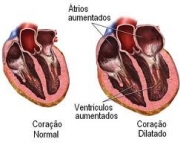foto-insuficiencia-cardiaca-congestiva-13