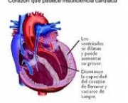 foto-insuficiencia-cardiaca-congestiva-15