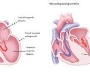 foto-miocardiopatia-hipertrofica-12
