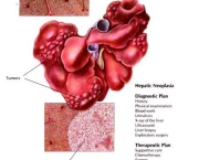 neoplasmas-tumores-benignos-e-malignos-5