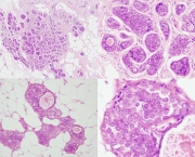 neoplasmas-tumores-benignos-e-malignos-1