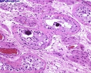 neoplasmas-tumores-benignos-e-malignos-2