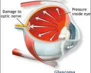o-que-e-glaucoma-6