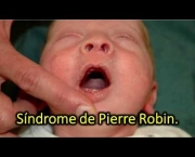 Síndrome de Pierre Robin (3)