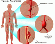 o-que-e-um-aneurisma-tratamento-e-sintomas-3