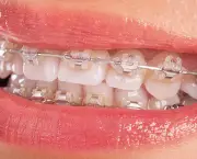 O Segredo dos Aparelhos Dentais (1)