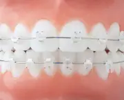 O Segredo dos Aparelhos Dentais (1)