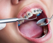 O Segredo dos Aparelhos Dentais (2)