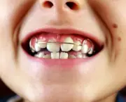 O Segredo dos Aparelhos Dentais (6)