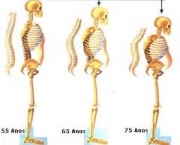 foto-osteoporose-02