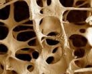 foto-osteoporose-05
