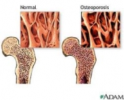 foto-osteoporose-10