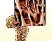 foto-osteoporose-15