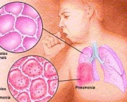 pneumonia1.jpg