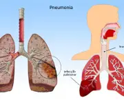 pneumonia-asiatica-12-perguntas-e-respostas-8