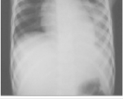 pneumonia-pediatrica-2