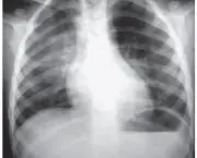 pneumonia-pediatrica-4