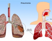 pneumonia-pediatrica-7