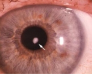 principais-doencas-dos-olhos-e-anexos-que-afetam-os-individuos-3