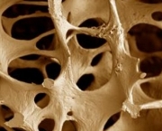 principais-sintomas-da-osteoporose-2