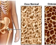 principais-sintomas-da-osteoporose-4