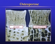 principais-sintomas-da-osteoporose-9