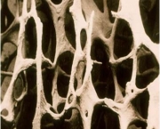 principais-sintomas-da-osteoporose-11