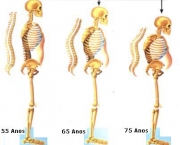 principais-sintomas-da-osteoporose-14
