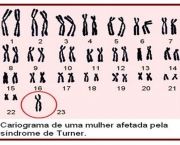 Cariograma-síndrome-de-turner