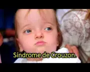 Síndrome de Crouzon (7)