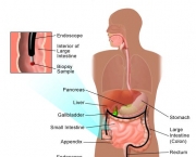 sindrome-do-intestino-irritavel-caracteristicas-gerais-9