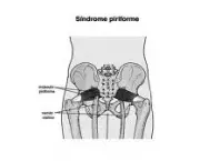 foto-sindrome-do-piriforme-15