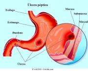 Sintomas da Úlcera Gástrica (2)