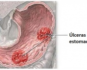 Sintomas da Úlcera Gástrica (6)