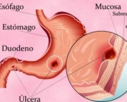 Sintomas da Úlcera Gástrica (14)
