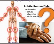 20120223_artrite_reumatoide.jpg