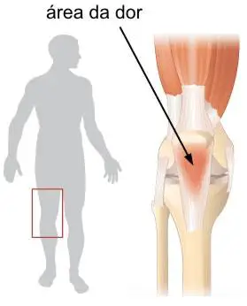 Resultado de imagem para tendinite no joelho