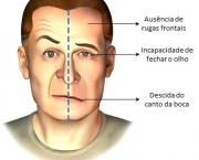 Tratamento da Paralisia Facial (1)
