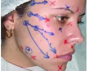 Tratamento da Paralisia Facial (3)