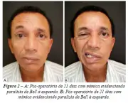 Tratamento da Paralisia Facial (4)