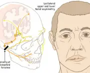 Tratamento da Paralisia Facial (5)